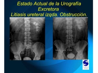 Estado Actual de la Urografía Excretora  Litiasis ureteral izqda. Obstrucción. 