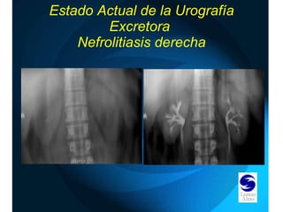 Estado Actual de la Urografía Excretora  Nefrolitiasis derecha 