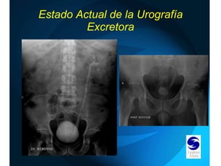 Estado Actual de la Urografía Excretora 