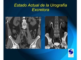 Estado Actual de la Urografía Excretora 