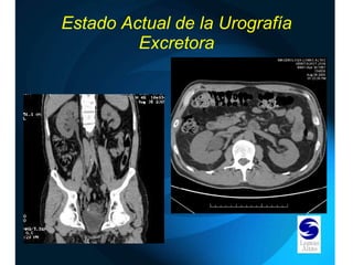 Estado Actual de la Urografía Excretora 