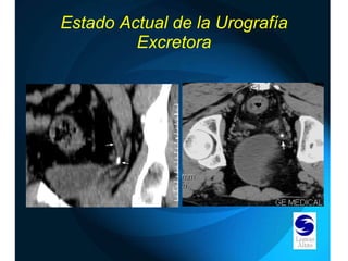 Estado Actual de la Urografía Excretora 