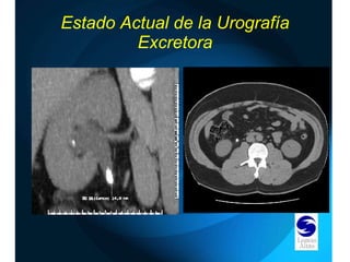 Estado Actual de la Urografía Excretora 