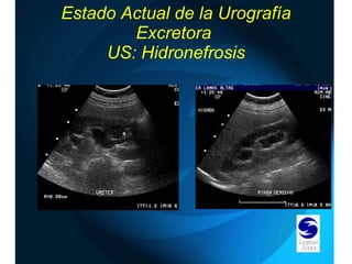 Estado Actual de la Urografía Excretora  US: Hidronefrosis 