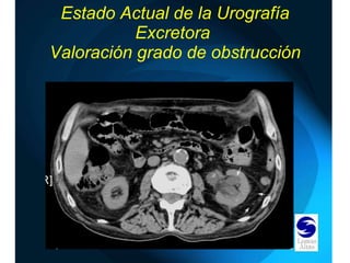 Estado Actual de la Urografía Excretora  Valoración grado de obstrucción 