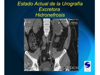 Estado Actual de la Urografía Excretora  Hidronefrosis 