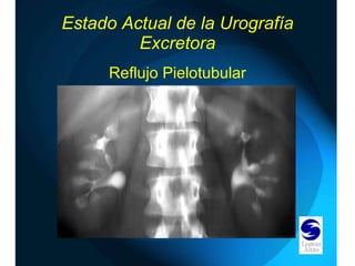 Estado Actual de la Urografía Excretora Reflujo   Pielotubular 