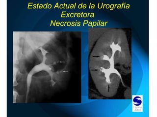 Estado Actual de la Urografía Excretora  Necrosis Papilar 