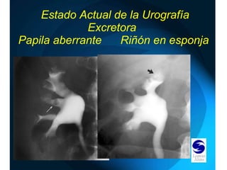   Estado Actual de la Urografía Excretora  Papila aberrante  Riñón en esponja 