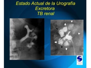 Estado Actual de la Urografía Excretora  TB renal 