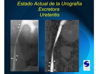 Estado Actual de la Urografía Excretora  Ureteritis 