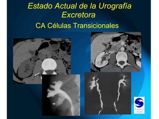 Estado Actual de la Urografía Excretora  CA Células Transicionales 