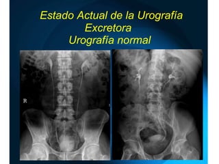   Estado Actual de la Urografía Excretora  Urografía normal 