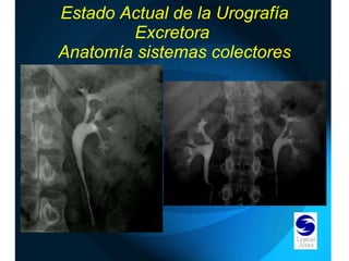 Estado Actual de la Urografía Excretora  Anatomía sistemas colectores 
