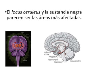 •El locus ceruleus y la sustancia negra
parecen ser las áreas más afectadas.
 