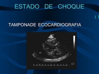 TAMPONADE ECOCARDIOGRAFIA
ESTADO DE CHOQUE
 