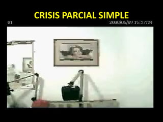 CRISIS PARCIAL SIMPLE
 