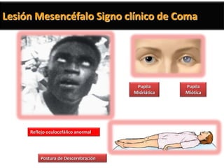 Lesión Mesencéfalo Signo clínico de Coma




                                      Pupila      Pupila
                                     Midriática   Miótica




     Reflejo oculocefálico anormal




         Postura de Descerebración
 