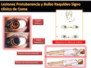 Lesiones Protuberancia y Bulbo Raquídeo Signo
clínico de Coma

                             Pupila
                             Miótica




                             Pupila
                            Midriática   Respuesta en cabeza de muñeca




          Postura de Decorticación



        Postura de Descerebración
 