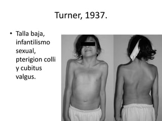 Turner, 1937.
• Talla baja,
infantilismo
sexual,
pterigion colli
y cubitus
valgus.

 