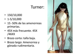 Turner:
• 150/10,000
• 1-5/10,000
• 15 -50% de las amenorreas
primarias.
• 45X más frecuente. 45X
/46XX
• Brazo corto: talla baja.
• Brazo largo: Amenorrea y
gónada rudimentaria.

 