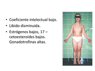 • Coeficiente intelectual bajo.
• Libido disminuida.
• Estrógenos bajos, 17 –
cetoesteroides bajos.
Gonadotrofinas altas.

 