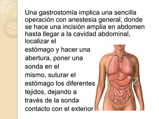 Una gastrostomía implica una sencilla
operación con anestesia general, donde
se hace una incisión amplia en abdomen
hasta llegar a la cavidad abdominal,
localizar el
estómago y hacer una
abertura, poner una
sonda en el
mismo, suturar el
estómago los diferentes
tejidos, dejando a
través de la sonda
contacto con el exterior
 