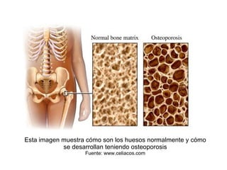 Esta imagen muestra cómo son los huesos normalmente y cómo se desarrollan teniendo osteoporosis Fuente: www.celiacos.com 