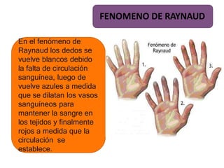 En el fenómeno de
Raynaud los dedos se
vuelve blancos debido
la falta de circulación
sanguínea, luego de
vuelve azules a medida
que se dilatan los vasos
sanguíneos para
mantener la sangre en
los tejidos y finalmente
rojos a medida que la
circulación se
establece.
FENOMENO DE RAYNAUD
 