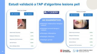 12
Estudi validació a l'AP d'algoritme lesions pell
44 DIAGNÒSTICS
►Patologia melanocítica benigna i
maligna
►Patologia tumoral benigna i
maligna.
►Patologia inflamatòria.
►Patologia infecciosa.
►Patologia genital.
 