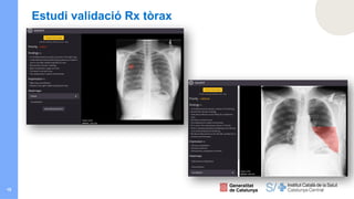 15
Estudi validació Rx tòrax
 