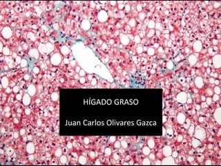 HÍGADO GRASO
Juan Carlos Olivares Gazca
 