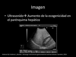 Imagen
• Ultrasonido Aumento de la ecogenicidad en
el parénquima hepático
Feldman M, Friedman L, Brandt L. Sleisenger and Fortrans gastrointestinal and liver disease. Saunders; 2010
 