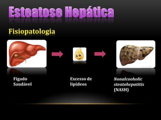 Fígado
Saudável
Excesso de
lipídeos
Nonalcooholic
steatohepatitis
(NASH)
 