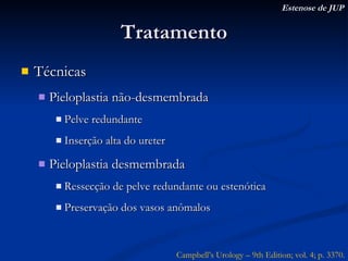 Tratamento Técnicas Pieloplastia não-desmembrada Pelve redundante Inserção alta do ureter Pieloplastia desmembrada Ressecção de pelve redundante ou estenótica Preservação dos vasos anômalos Estenose de JUP Campbell’s Urology – 9th Edition; vol. 4; p. 3370. 
