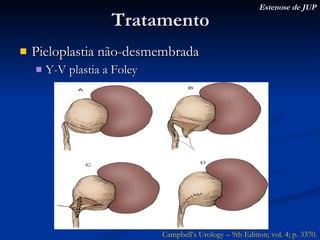 Tratamento Pieloplastia não-desmembrada Y-V plastia a Foley Estenose de JUP Campbell’s Urology – 9th Edition; vol. 4; p. 3370. 