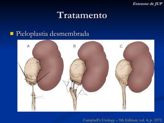 Tratamento Pieloplastia desmembrada Estenose de JUP Campbell’s Urology – 9th Edition; vol. 4; p. 3372. 