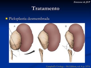 Tratamento Pieloplastia desmembrada Estenose de JUP Campbell’s Urology – 9th Edition; vol. 4; p. 3374. 