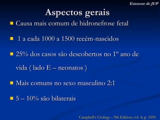 Aspectos gerais Causa mais comum de hidronefrose fetal 1 a cada 1000 a 1500 recém-nascidos 25% dos casos são descobertos no 1º ano de vida ( lado E – neonatos ) Mais comuns no sexo masculino 2:1 5 – 10% são bilaterais Estenose de JUP Campbell’s Urology – 9th Edition; vol. 4; p. 3359. 