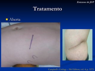 Tratamento Aberta Estenose de JUP Campbell’s Urology – 9th Edition; vol. 4; p. 3373. 