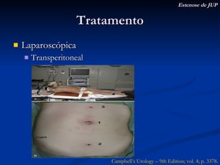 Tratamento Laparoscópica Transperitoneal Estenose de JUP Campbell’s Urology – 9th Edition; vol. 4; p. 3378. 