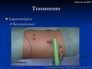 Tratamento Laparoscópica Retroperitoneal Estenose de JUP Campbell’s Urology – 9th Edition; vol. 4; p. 3377. 
