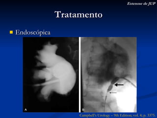 Tratamento Endoscópica Estenose de JUP Campbell’s Urology – 9th Edition; vol. 4; p. 3375. 