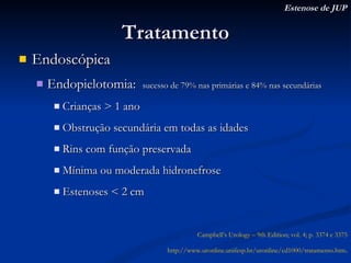 Tratamento Endoscópica Endopielotomia:  sucesso de 79% nas primárias e 84% nas secundárias  Crianças > 1 ano Obstrução secundária em todas as idades Rins com função preservada Mínima ou moderada hidronefrose Estenoses < 2 cm Estenose de JUP Campbell’s Urology – 9th Edition; vol. 4; p. 3374 e 3375 http://www.uronline.unifesp.br/uronline/ed1000/tratamento.htm . 