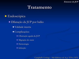 Tratamento Endoscópica Dilatação da JUP por balão Validade incerta Complicações: Obstrução aguda da JUP Migração do stent Hemorragia  Infecção Estenose de JUP Campbell’s Urology – 9th Edition; vol. 4; p. 3374 e 3375. 