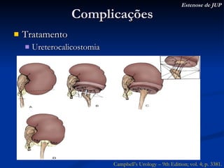 Complicações Tratamento Ureterocalicostomia Campbell’s Urology – 9th Edition; vol. 4; p. 3381. Estenose de JUP 