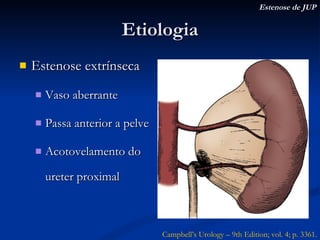 Etiologia Estenose extrínseca Vaso aberrante Passa anterior a pelve Acotovelamento do ureter proximal Estenose de JUP Campbell’s Urology – 9th Edition; vol. 4; p. 3361. 