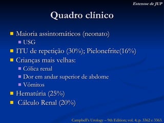 Quadro clínico Maioria assintomáticos (neonato) USG ITU de repetição (30%); Pielonefrite(16%) Crianças mais velhas: Cólica renal Dor em andar superior de abdome Vômitos Hematúria (25%) Cálculo Renal (20%) Estenose de JUP Campbell’s Urology – 9th Edition; vol. 4; p. 3362 e 3363. 