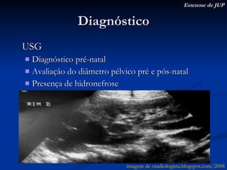 Diagnóstico USG Diagnóstico pré-natal Avaliação do diâmetro pélvico pré e pós-natal Presença de hidronefrose Estenose de JUP imagem de oradiologista.blogspot.com/2008 