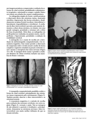 einstein. 2008; 6 (Supl 1):S29-S32
Estenose do canal vertebral cervical e lombar S31
por imagem permitem a compreensão e avaliação da es-
tenose do canal vertebral, possibilitando o planejamen-
to terapêutico, valorizando-se sempre o quadro clínico
em relação aos achados dos exames complementares.
As radiograﬁas simples de frente e perﬁl permitem
a observação direta das estruturas ósseas, mostrando
osteóﬁtos, degeneração das facetas articulares, desali-
nhamentos no plano frontal (escoliose e laterolistese) e
lateralmente (espondilolistese e retrolistese). A avalia-
ção do disco intervertebral é precária, pois somente de-
monstra a altura dessa estrutura, no entanto, tem uma
grande vantagem, permitindo a ortostase sob o efeito
da força da gravidade. Além disso, as radiograﬁas em
perﬁl podem ser realizadas em posição neutra, com hi-
perﬂexão e hiperextensão, permitindo a avaliação da
estabilidade vertebral.
A mielograﬁa era o exame de escolha até a intro-
dução da mielotomograﬁa computadorizada e da res-
sonância magnética. Esse exame permite a observação
da compressão sobre o tecido neural e avaliar de forma
completa o segmento estudado na porção central do ca-
nal e mesmo a emergência das raízes nervosas (Figura
1A e 1B). A vantagem deste exame é permitir a avalia-
ção dinâmica da coluna vertebral, inclusive nas mano-
bras de ﬂexão e extensão.
A tomograﬁa computadorizada possibilita avaliar a
forma do canal vertebral, principalmente das estrutu-
ras ósseas responsáveis pelo estreitamento (Figura 2).
Também permite observar o disco intervertebral e as
estruturas neurais.
A ressonância magnética é o método de escolha
para avaliação das estenoses vertebrais, em cortes sa-
gitais (Figura 3), coronais e axiais. Tem as vantagens
de não submeter o paciente à irradiação e, principal-
mente, demonstrar as estruturas nervosas e disco in-
tervertebral com muito melhor deﬁnição do que os
demais métodos.
Figura 2. Imagem axial de tomograﬁa computadorizada de coluna vertebral
lombar (janela para partes moles) mostrando severa estenose de canal vertebral,
com hipertroﬁa das facetas articulares
Figura 1. Mielograﬁa de frente (A) e perﬁl (B) mostrando estenose de canal
vertebral lombar L4-L5, associado à espondilolistese degenerativa
A B
Figura 3. Imagem sagital, ponderada em T2, de ressonância magnética
mostrando estenose do canal vertebral nos níveis C3-C4, C5-C6 e C6-C7 e
mielopatia no nível C4-C5, local em que foi realizada descompressão neural com
fusão desse segmento
 